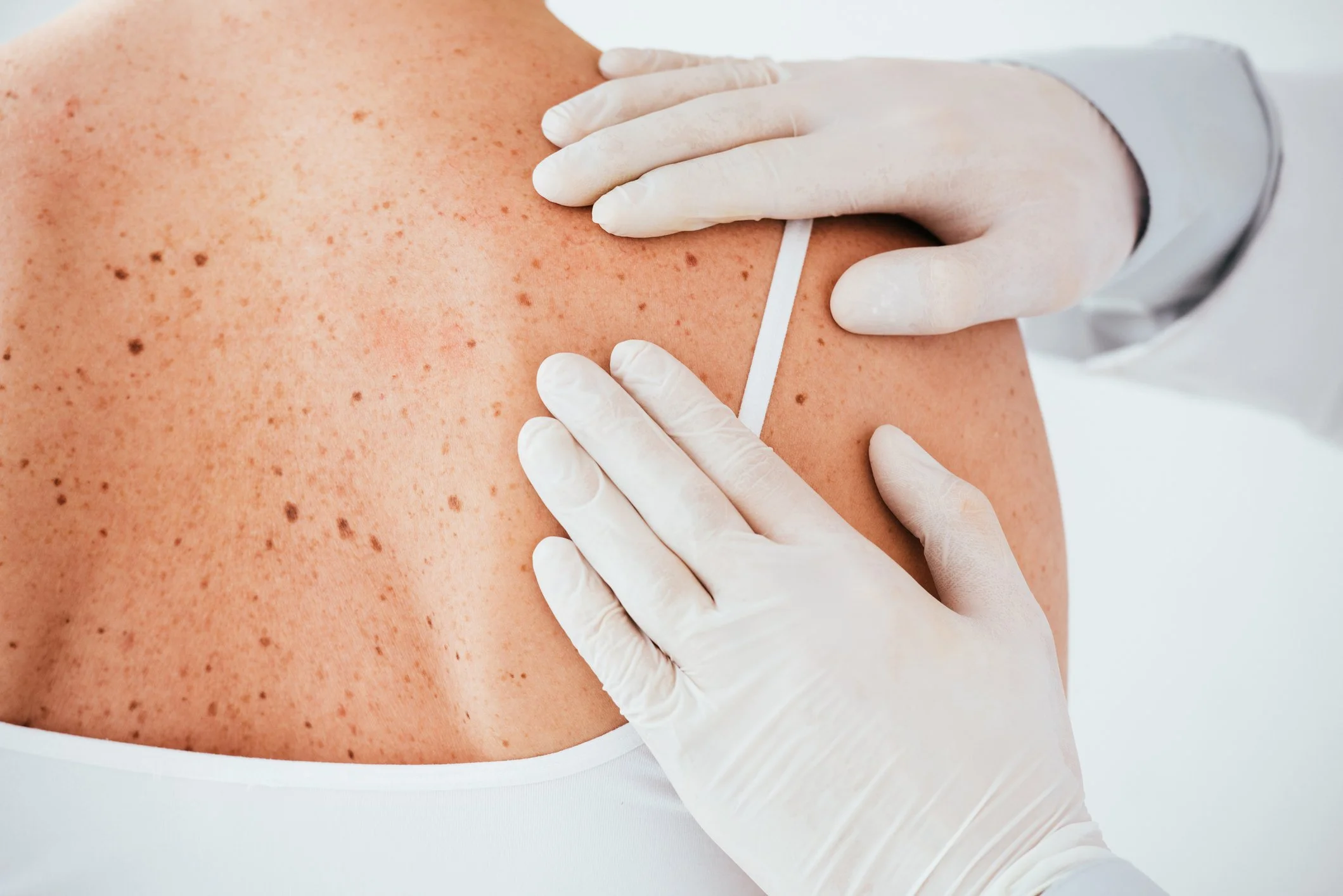 Mohs Surgery
